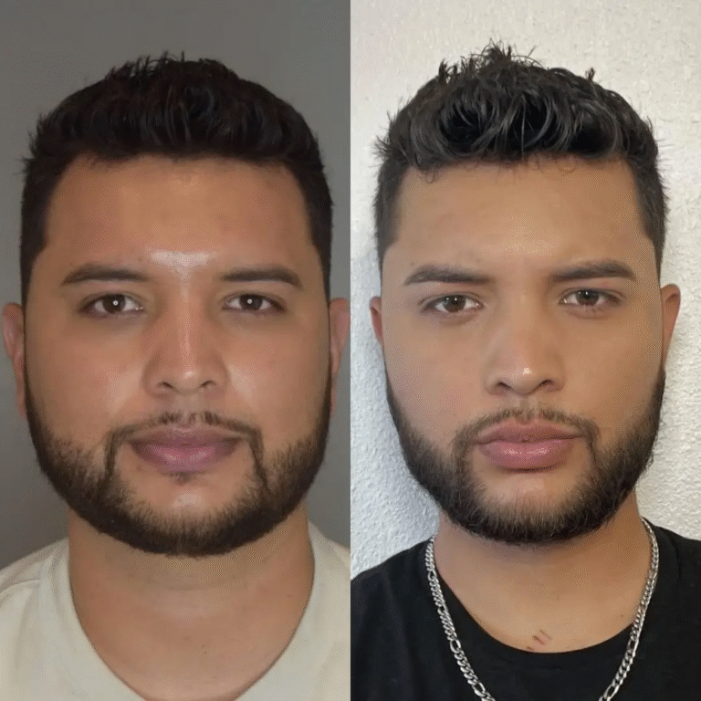 Buccal Fat Removal