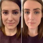 Prp Treatment in Dubai