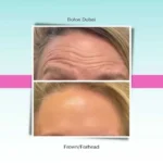 botox-frown-forhead