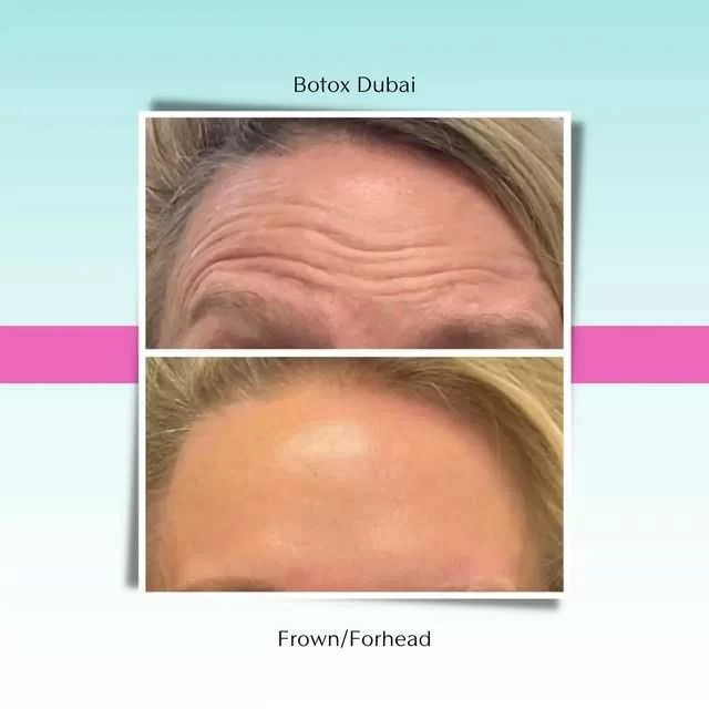 botox-frown-forhead