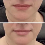 Jawline Contouring West Loop