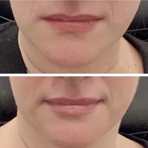 Jawline Contouring West Loop