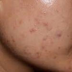 Effective Acne Scar Solutions in Dubai for All Skin Types