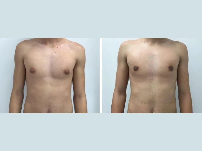 H1-Gynecomastia