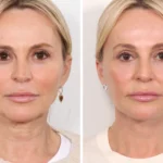 Experience Natural Skin Tightening Benefits at Best Aesthetic Clinics in Dubai Using Unique Thread Lift
