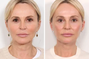 Thread lift in Dubai