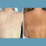 H14-Moxi®-Laser-treatment