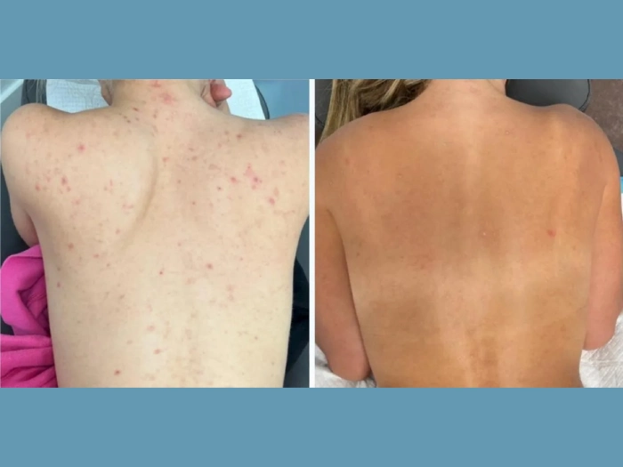 H14-Moxi®-Laser-treatment