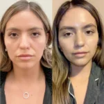 Achieve a Lifted Look Instantly with Thread Lift by Best Doctors in Dubai