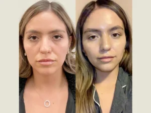 Best Plastic Surgeon in Dubai Offer Thread Lift to Rejuvenate Skin Without Surgery