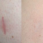 How to Treat Facial Scars Effectively in Dubai