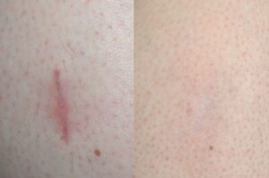 How to Treat Facial Scars Effectively in Dubai