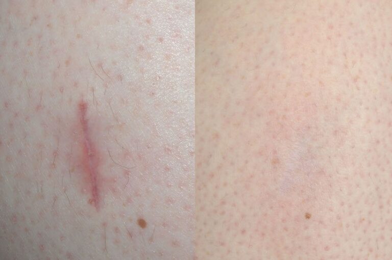 How to Treat Facial Scars Effectively in Dubai