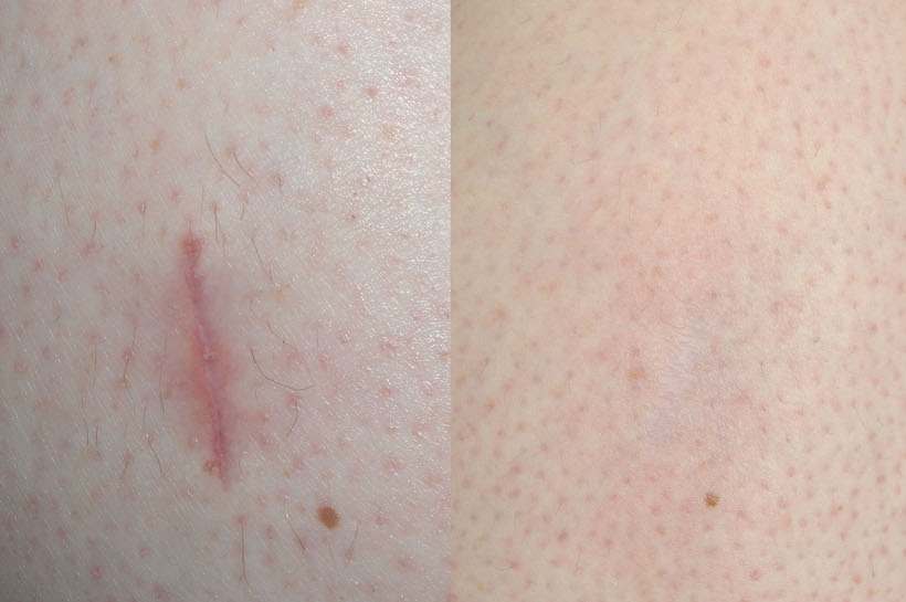 How to Treat Facial Scars Effectively in Dubai