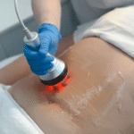 Slimmer Silhouette with Laser Liposuction in Dubai