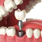 Dental Implant