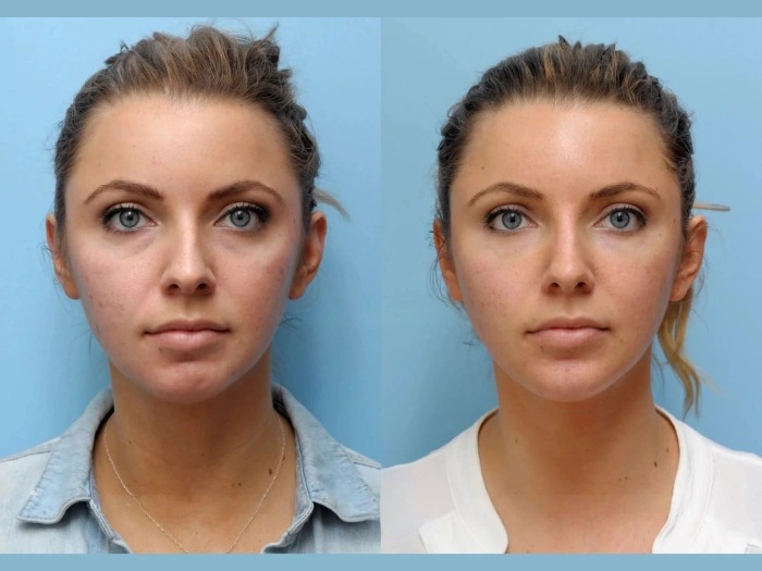 Benefits of Choosing Best Plastic Surgeons in Dubai for Thread Lift Procedures