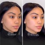 Smooth and Define Facial Contours at the Best Aesthetic Clinics in Dubai with Thread Lift