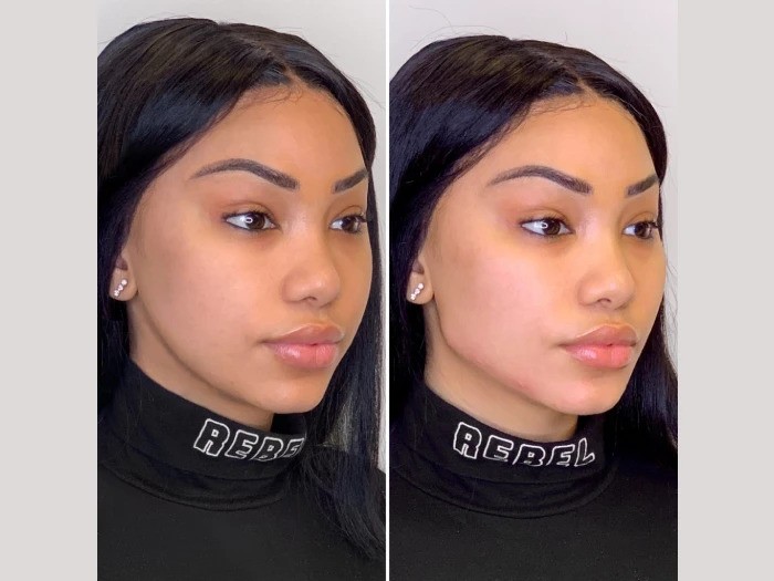 Smooth and Define Facial Contours at the Best Aesthetic Clinics in Dubai with Thread Lift