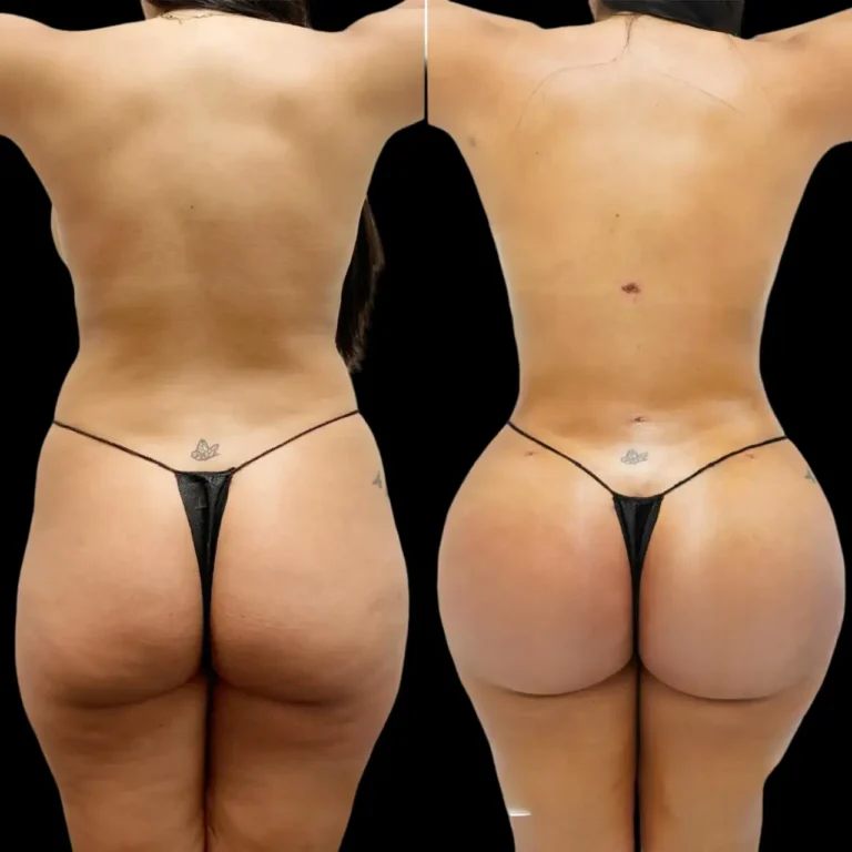 butt fat transfer