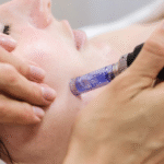 Microneedling In Manchester