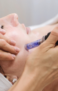 Microneedling In Manchester