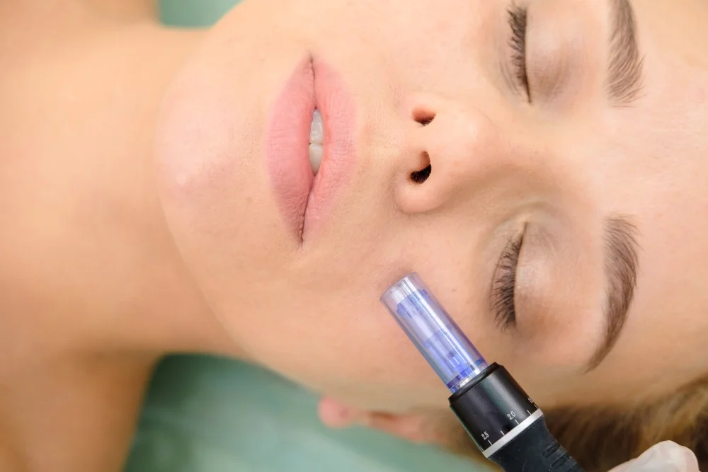micro needling