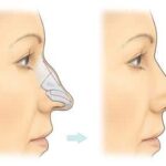 rhinoplasty in islamabad