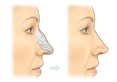 rhinoplasty in islamabad
