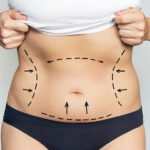 Liposuction Dubai