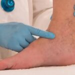 Chronic Venous Insufficiency Social Security Disability