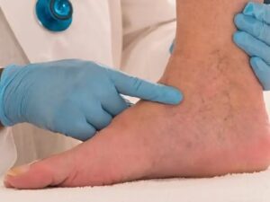 Chronic Venous Insufficiency Social Security Disability