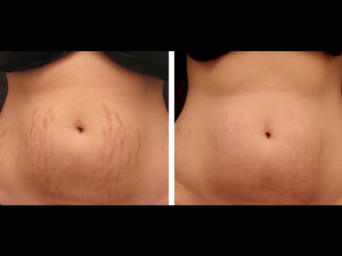 Radiofrequency (RF) Microneedling in dubai