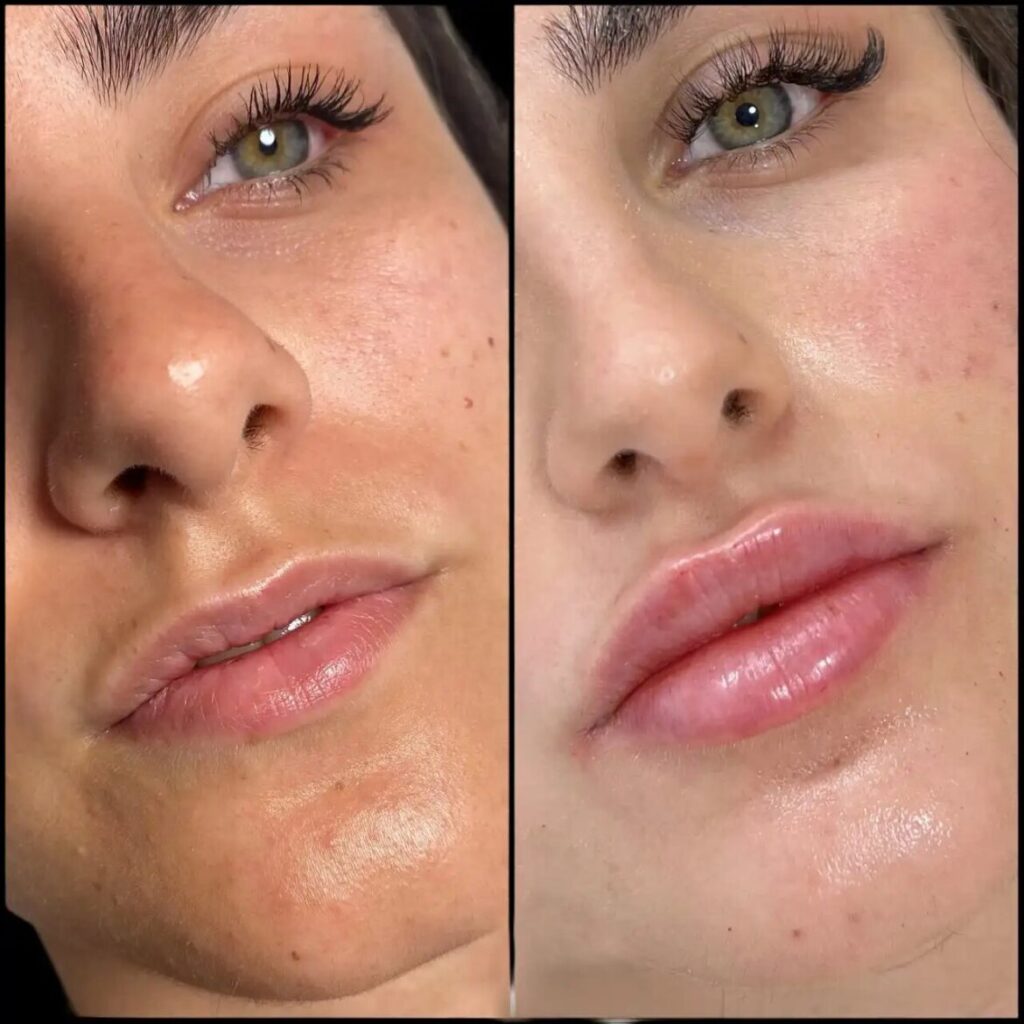 H8-lip-fillers-1170x1170