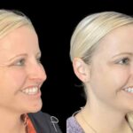 Botox in Dubai for Personalized Aesthetic Enhancements