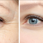 Before and after botox forehead wrinkles