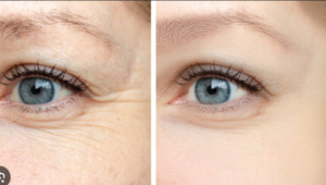 Before and after botox forehead wrinkles