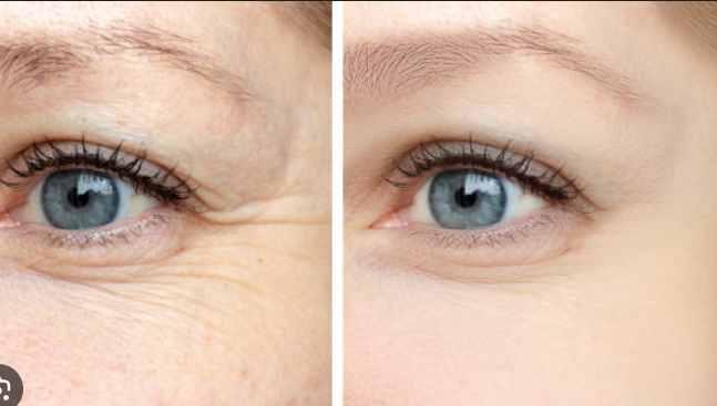 Before and after botox forehead wrinkles