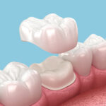 Dental Crowns and Bridges Dubai