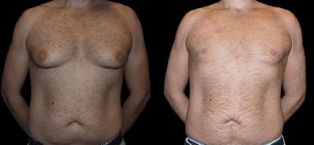 H-Gynecomastia-4