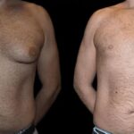 H-Gynecomastia-4