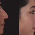 Septoplasty in Dubai