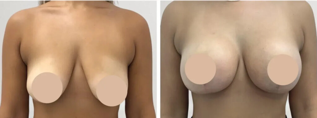 breast reduction in Dubai