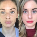 RF-Microneedling in duabi