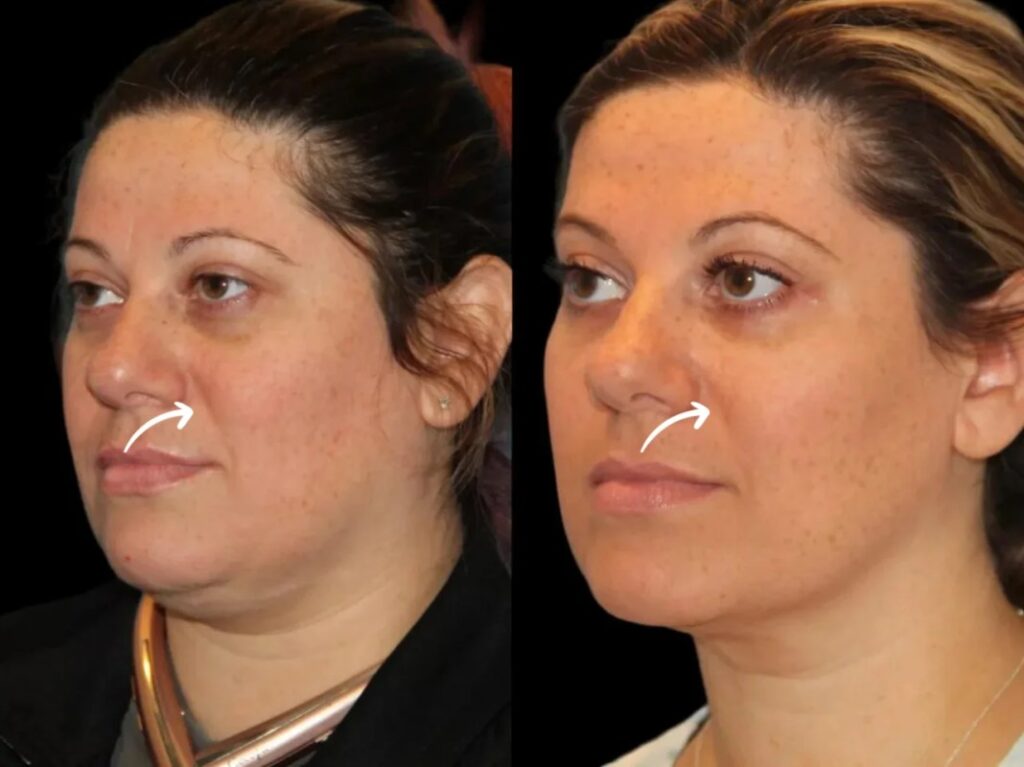sculptra fillers in dubai