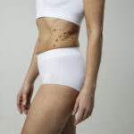 Liposuction in Dubai