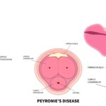 Peyronies Disease Wave Therapy