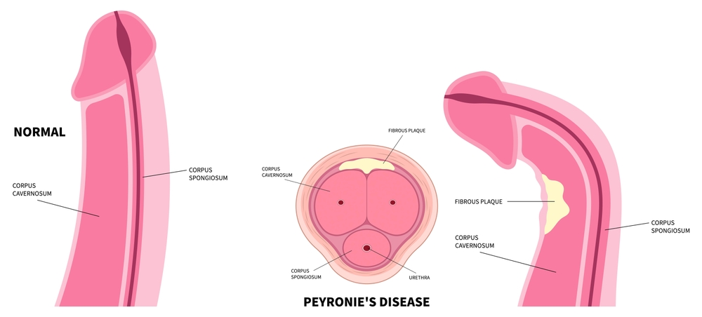 Peyronies Disease Wave Therapy