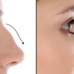 Rhinoplasty in Dubai