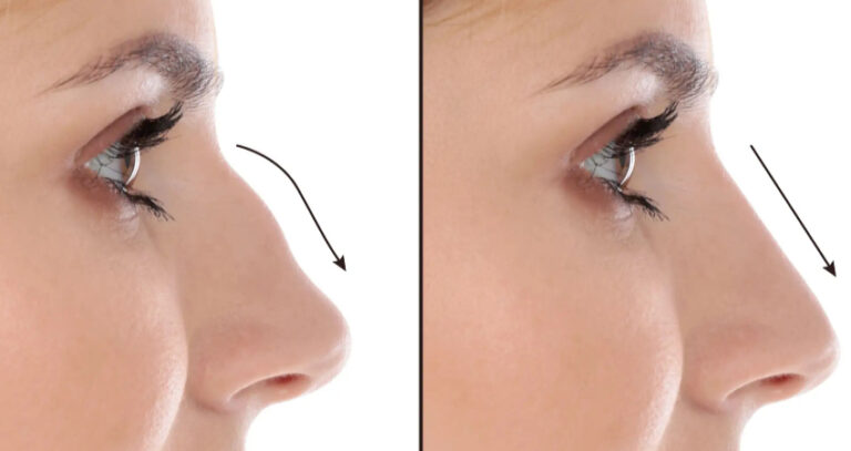 Rhinoplasty in Dubai